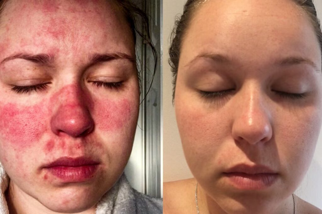 my facebefore and after