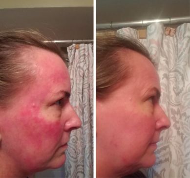 skinbefore and after